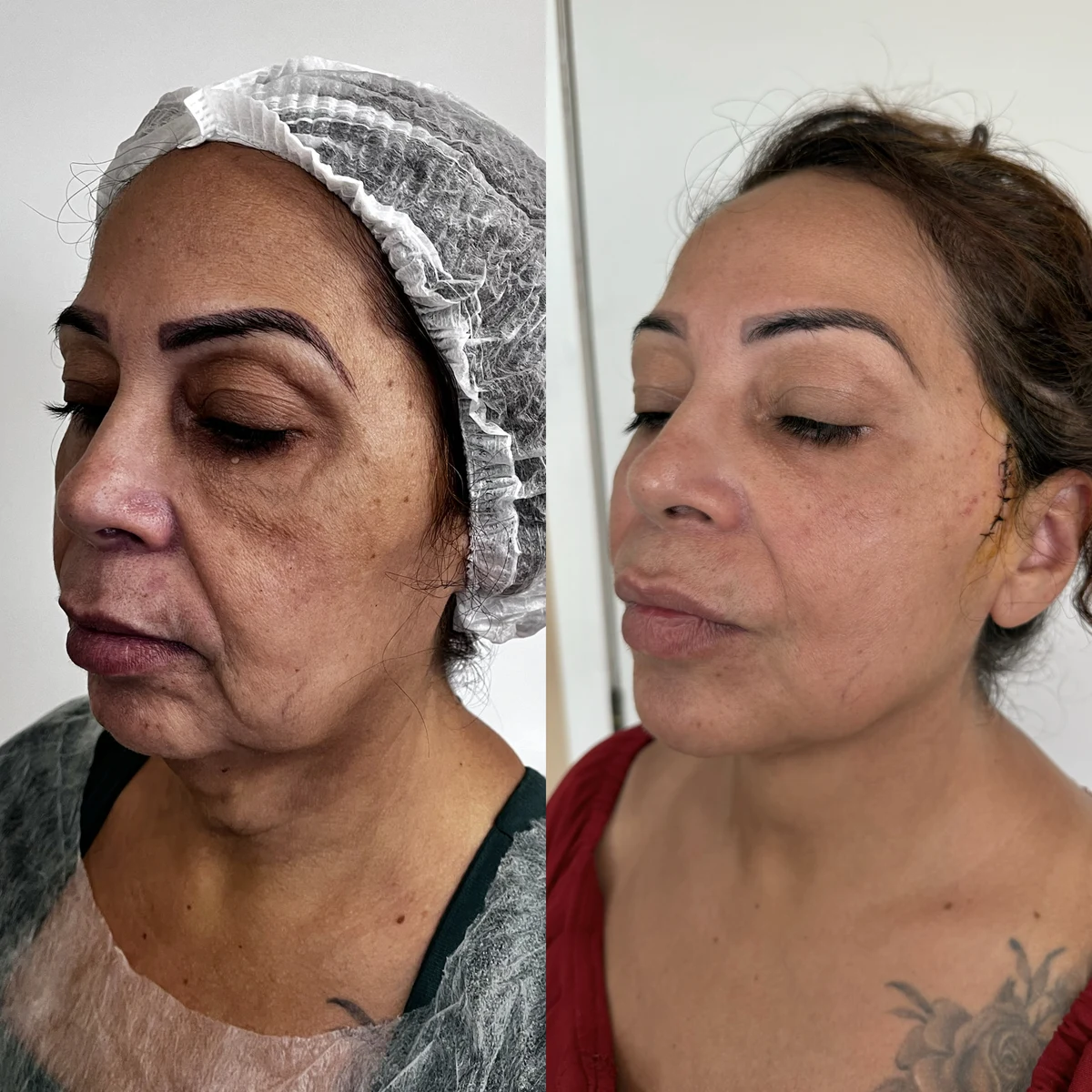Lipoaspiração de Papada