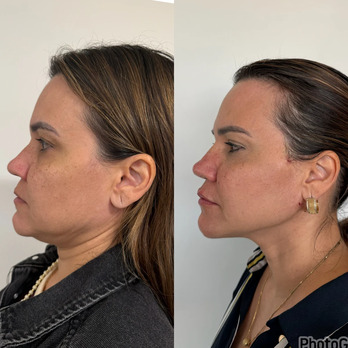 Rejuvenescimento Definitivo